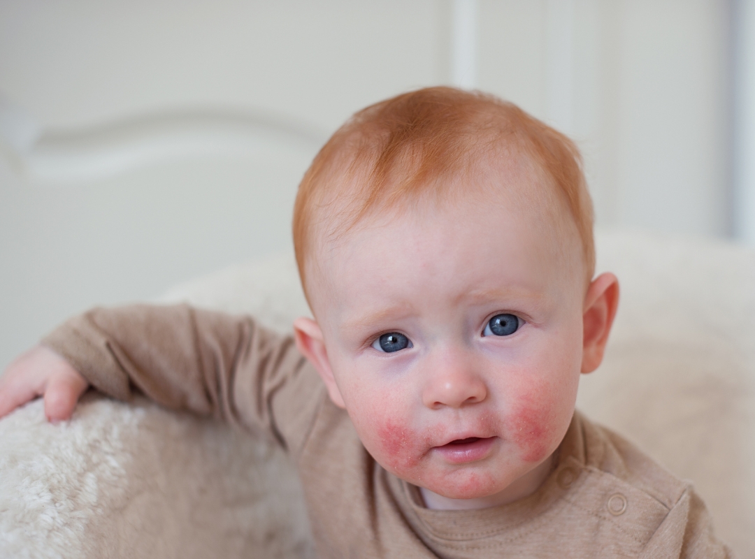 Gestão da Dermatite Atópica: Estratégias para Controle a Longo Prazo