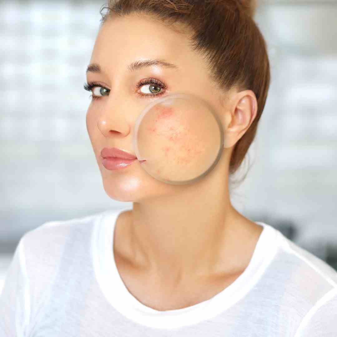 Imagem da especialidade: Tratamento de Cicatrizes de Acne (Microagulhamento, Fenol)