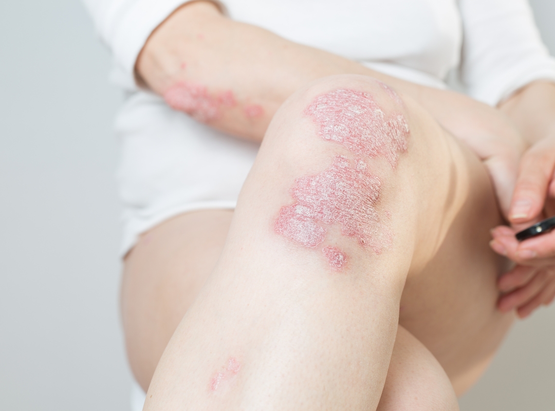 Você Sabia? 5 Curiosidades Sobre Psoríase que Você Nunca Imaginou