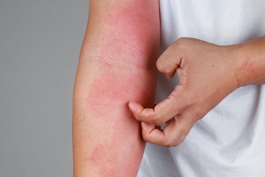 Como estar sempre preparado para o Eczema: Dicas essenciais para manter sua pele saudável