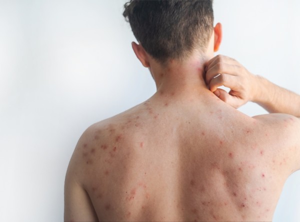 Avanços no Tratamento da Psoríase em 2026: O Que Já Está Disponível no Brasil
