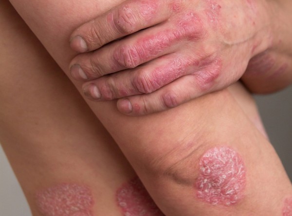 A Verdade Por Trás das Polêmicas em Torno da Cura da Psoríase