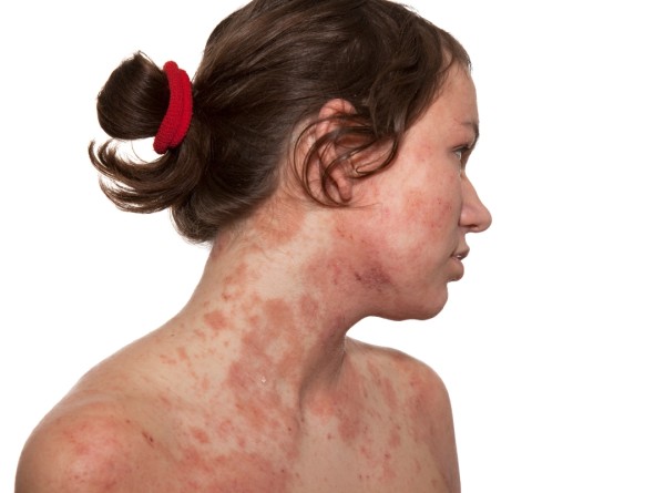 Dermatite Atópica: Trate Antes que a cicatriz psicológica se instale